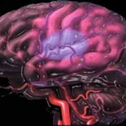 Почему возникает инсульт?