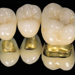 Зубные протезы и импланты будут более легкими и крепкими.